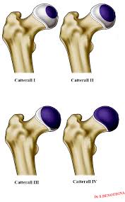 Perthes disease involves disruption of blood flow to the femoral head, causing avascular necrosis of the bone. Legg Calve Perthes Disease Catterall Classification Radiology Case Radiopaedia Org