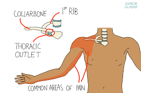 Thoracic Outlet Syndrome Tos Freya Gilmore