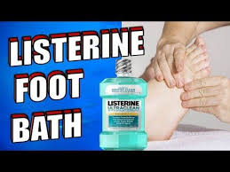 Vinegar is an antifungal that can be mixed with water to create a foot soak. Epic Natural Health Has A Passion For All Things Natural And Helps People Live A More Healthy Natural Happy Lif Listerine Listerine Feet Listerine Foot Soak