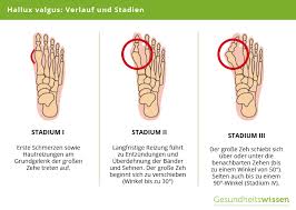 Hallux Valgus Ursachen Symptome Diagnose Behandlung
