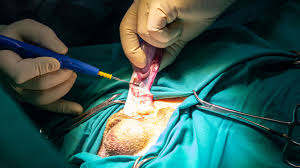 Typical symptoms are a painless swelling or lump in 1 of the testicles, or any change in shape or texture of the testicles. Testicular Surgery Preparation Recovery Long Term Care