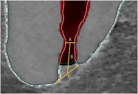 Other articles where sacral foramen is discussed: Three Dimensional Analysis Of The Physiological Foramen Geometry Of Maxillary And Mandibular Molars By Means Of Micro Ct International Journal Of Oral Science