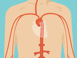 ascending aortic aneurysm repair surgery and size criteria