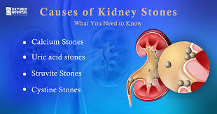 Image result for Calcium Nephrolithiasis