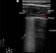 In addition, comet tail arti … Sonographische Bildgebung Der Lunge Bei Covid 19 Springerlink