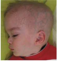 PDF) GM2-Gangliosidosis (Sandhoff and Tay Sachs disease): Diagnosis and  Neuroimaging Findings (An Iranian Pediatric Case Series)