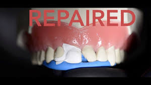 However, broken tooth treatment cost without insurance can vary: Cracked Broken Chipped Tooth Repair Treatment Pain Relief