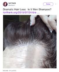 Since hair loss isn't life threatening, some physicians won't even treat it. Does Wen Cause Hair Loss