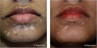 Image result for Postinflammatory Hypopigmentation