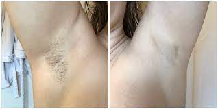 We offer this treatment to residents of new orleans, mandeville, covington and slidell, la. Gemischt Privatsphare Defekt Laser Shave I Kaiserfeld At