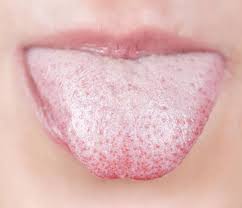 Most people's tongues and mouths are dirty, but that's a totally normal thing for your. 10 Natural Treatments For White Tongue
