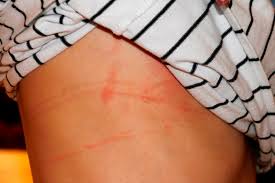 Image result for heat rash under breasts