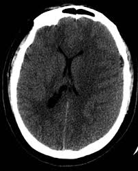 Subdural Hematoma An Overview Sciencedirect Topics