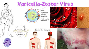 Image result for Varicella zoster on human skin