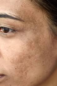 Milia is a skin disorder characterized by small white, hard bump son skin. 8 Common Skin Problems And How To Fix Them Acne And Rosacea Advice