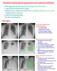 Image result for Air Bronchogram