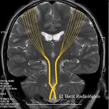 Se estima que más de la mitad de las motoneuronas se pierden antes de que comiencen a aparecer síntomas evidentes que pueden incluir. Radiologia En La Red Esclerosis Lateral Amiotrofica Hallazgos En Tomografia Por Resonancia Magnetica Amyotrophic Lateral Sclerosis Mri Findings Radiologia De Trinchera