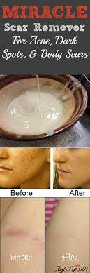 Miracle Homemade Scar Remover For Acne And Dark Spots Recipe Acne Dark Spots Beauty Remedies Skin Treatments