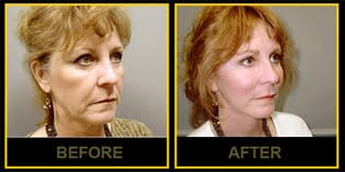 Our wild elf ear is about 2 and a half inches in length, and has a nice gentle curve and detailed. Ear Surgery Otoplasty Nashville Green Hills Plastic Surgery