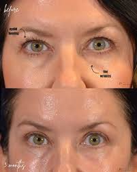 👀 Looking radiant 3 months after an upper blepharoplasty and ContourTRL  Erbium laser skin resurfacing around the eyes (under local anesthesia) to  address eyelid hooding and fine wrinkles. Interested in upper eyelid