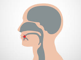 The larynx contains the vocal cords, which vibrate and make sound when air is directed against them. About Vocal Cord Cancer Causes Symptoms And Treatments The Most Common Throat Cancer Laryngeal Cancer