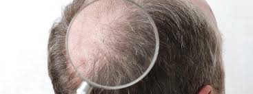 Complete regrowth may take months or years to occur. How Many Grafts Needed For A Hair Transplant Sule Hair Transplant