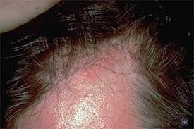 Some home remedies provide relief from the symptoms of face flushing, but other natural cures can. 10 Reasons Your Face Is Red
