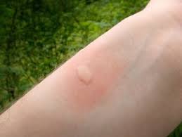 Bug Bites That Look Like Mosquito Bites But Aren T Pin On Injury Scenarios