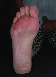 Image result for brown patches on the feet