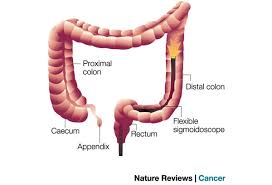 Its accuracy in detecting cancer varies but can be as high as 70 percent. Services Colorectal Cancer In Pune India