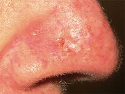 If you have a scar or consistently have sores on your skin, squamous cell carcinoma may form there. Types Of Skin Cancers Transplant Skin Cancer Network
