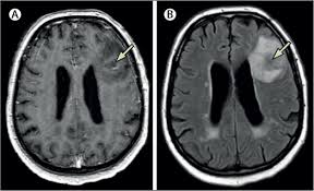 Image result for Brain Abscess