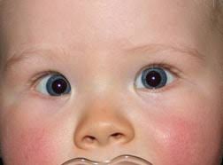 Increased space between 1st and 2nd toes; Pseudostrabismus American Association For Pediatric Ophthalmology And Strabismus