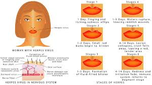 How To Get Rid Of Cold Sores Fast Plushcare