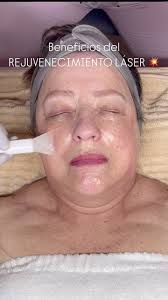 Mediante este procedimiento se consigue una estimulación dérmica, a nivel  de la dermis papilar y reticular superior con el fin de estimular los  fibroblastos y aumentar la producción de colágeno, ...