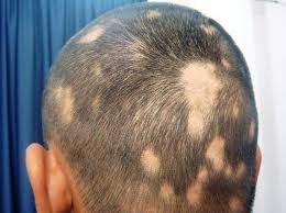 A typical hair transplant involves removing patches of hair from your head and reinserting the hair follicle by follicle into the bald sections. Alopecia Hair Loss No One Need Ever See Your Bald Patches With This Steemit