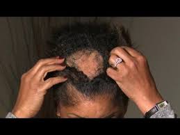 Hairstyles for thinning hair on top black female. Ccca Alopecia Scarring Alopecia Friendly Black Hair Styles Sydneynicolehair Com Skyler Hairstyles Jour Black Women Hair Loss Hair Loss Women Extreme Hair