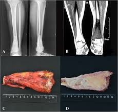 In most cases, the symptoms become gradually more severe with time. Novel Double Strut Fibula Ankle Arthrodesis For Large Tumor Related Bone Defect Of Distal Tibia Bmc Musculoskeletal Disorders Full Text