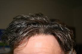 La migliore soluzione d'infoltimento non chirurgico per risolvere la. Protesi Capelli In Lace New Hair System