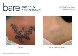 Picosure laser tattoo removal in springfield, illinois. Laser Tattoo Removal Munster In Chicago Il Bare Tattoo Hair Removal