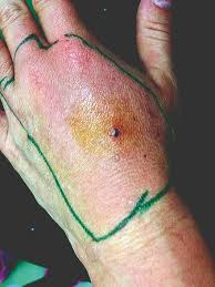 Jul 21, 2021 · sepsis is a clinical syndrome that has physiologic, biologic, and biochemical abnormalities caused by a dysregulated host response to infection. Therapie Bei Bissverletzungen Bis S Zum Septischen Schock Klinik Via Medici