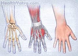 A mallet finger is a deformity of the finger caused when the tendon that straightens your finger is damaged, commonly caused by a direct blow to the fingertip. Mallet Finger Definition Causes Symptoms Complications And Cost Surgery Treatment Hospital In India