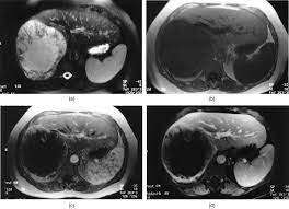 Maybe you would like to learn more about one of these? Primary Malignant Mesothelioma Of The Liver Mr Imaging Findings Sciencedirect