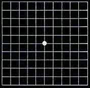 Macular Degeneration
