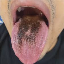 Image result for black hairy tongue symptoms