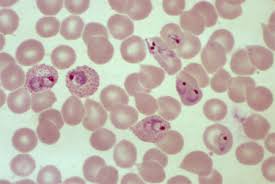 Deep focus , malaria parasite (p.f) shoot by dslr under microscope 1000x, malaria parasite microscope. Clinical Zoom In Cerebral Malaria A Brazilian U Va Med Student In Mozambique