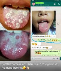 Maybe you would like to learn more about one of these? Obat Sariawan Akut Radang Tenggorokan Amandel Pemutih Gigi Shopee Indonesia