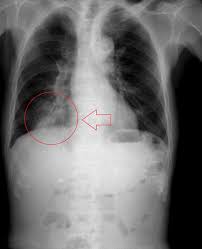 Image result for Pneumonia