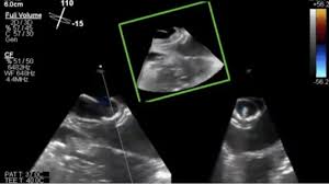 Scar Detection By Pulse-Cancellation Echocardiography: Validation By Cmr In  Patients With Recent Stemi - Sciencedirect