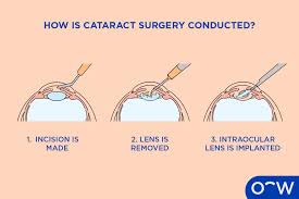 Image result for Cataract Extraction